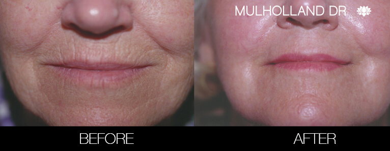 Fractora - Before and After Gallery – Photo 45