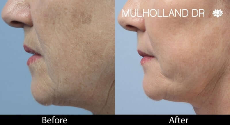 Fractora - Before and After Gallery – Photo 30