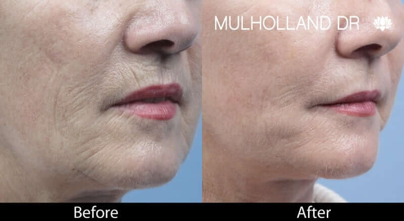 Fractora - Before and After Gallery – Photo 31