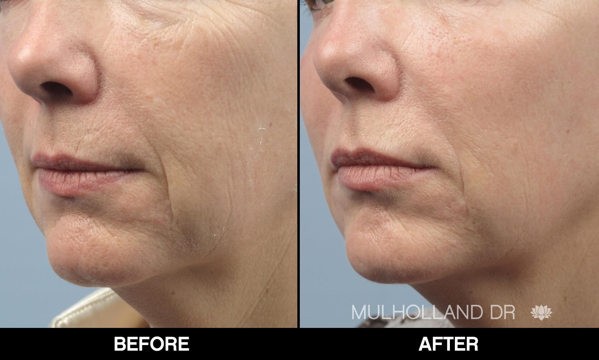 Fractora - Before and After Gallery – Photo 69