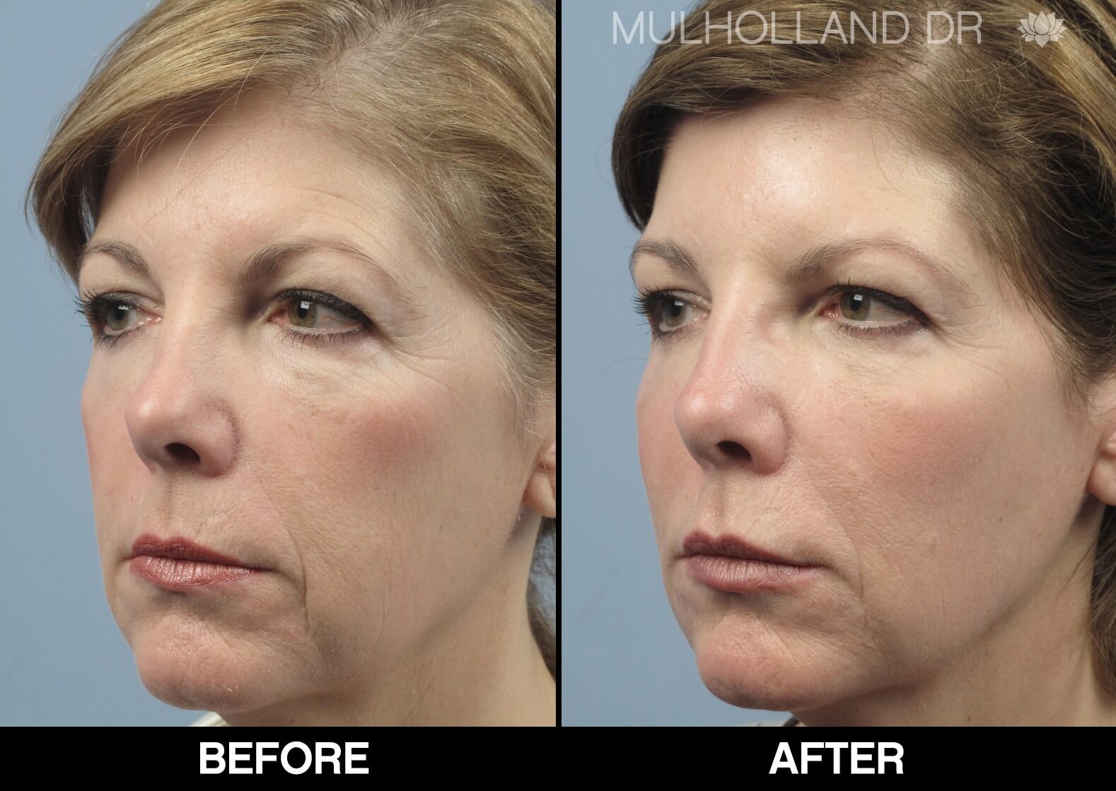 Fractora - Before and After Gallery – Photo 72