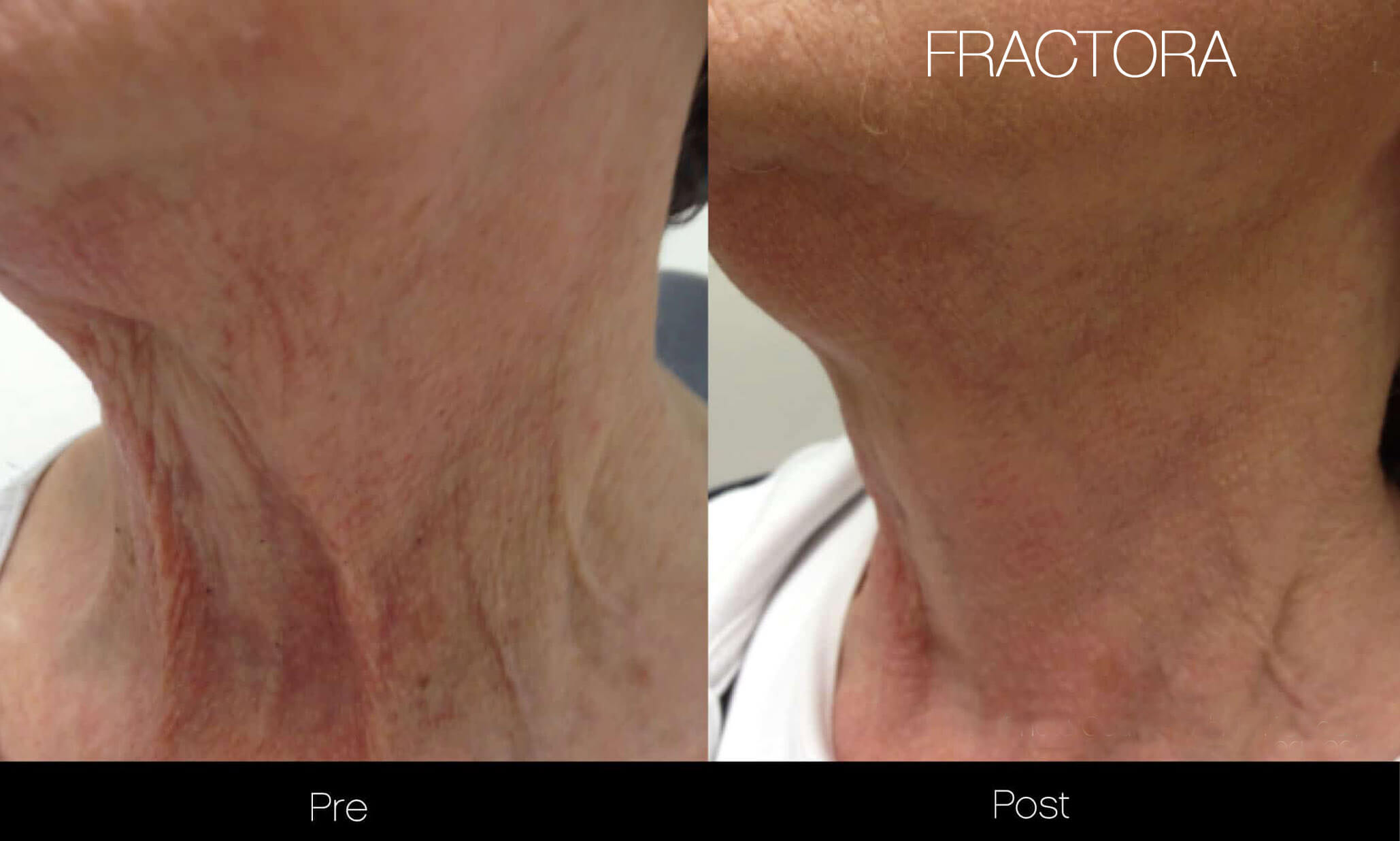 Fractora - Before and After Gallery – Photo 24