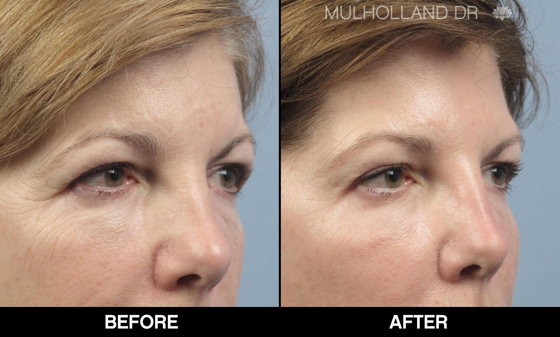 Fractora - Before and After Gallery – Photo 74