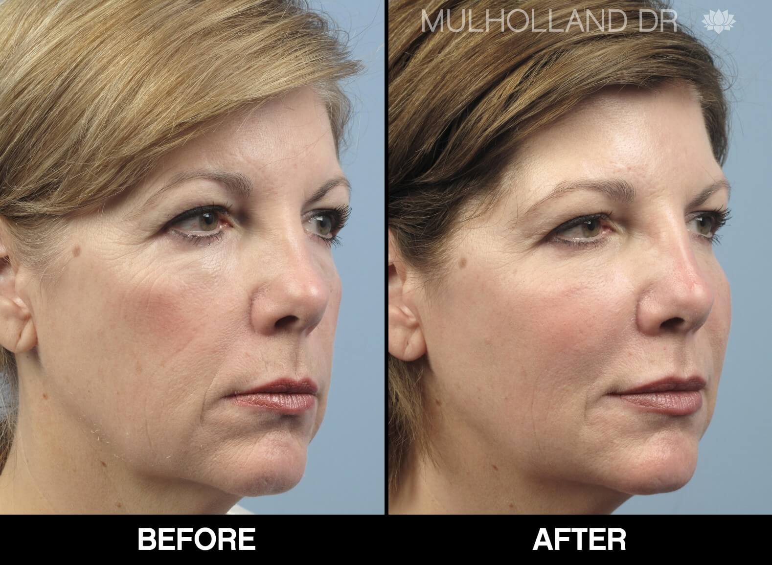 Fractora - Before and After Gallery – Photo 76