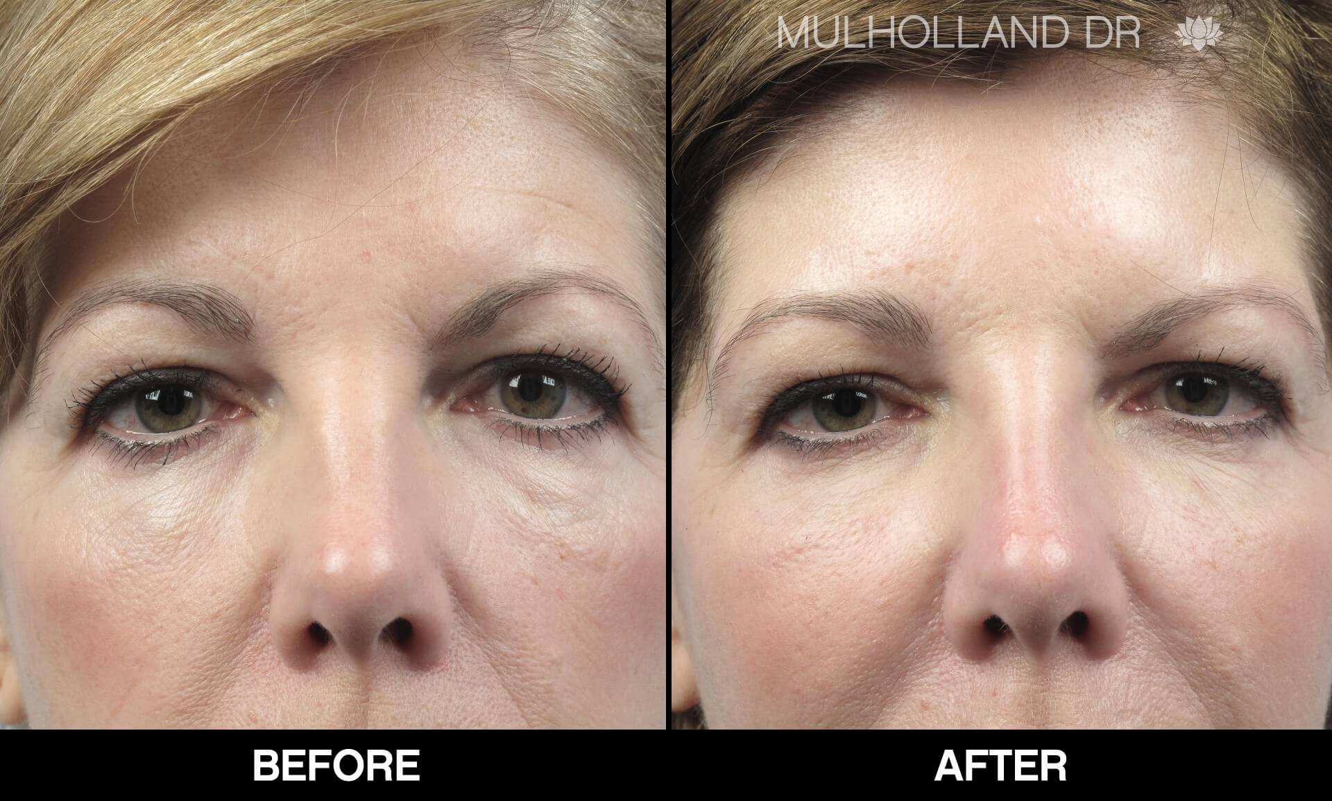 Fractora - Before and After Gallery – Photo 77