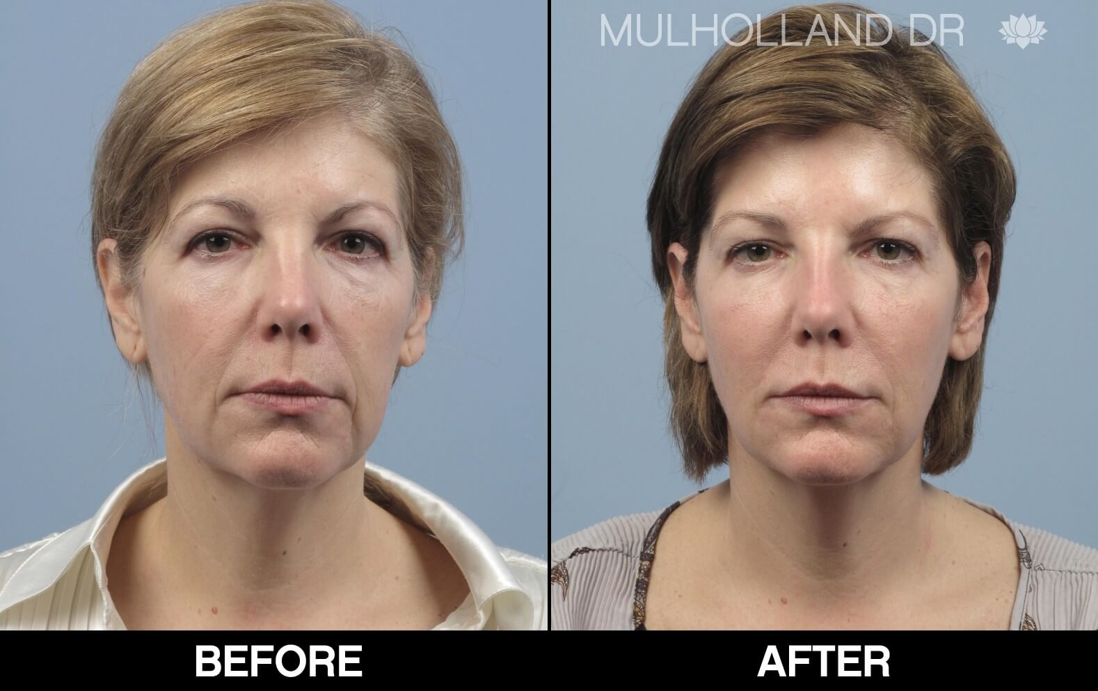 Fractora - Before and After Gallery – Photo 78