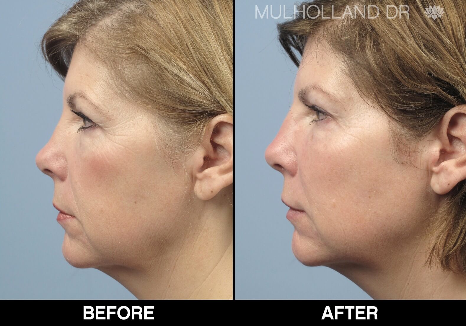 Fractora - Before and After Gallery – Photo 82