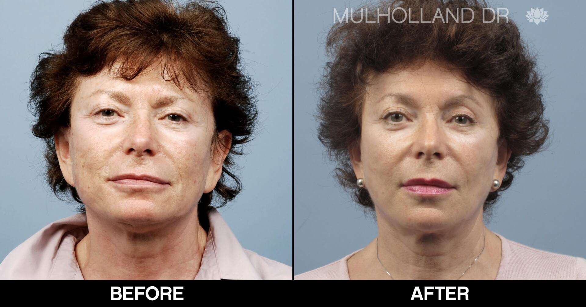 Fractora - Before and After Gallery – Photo 56