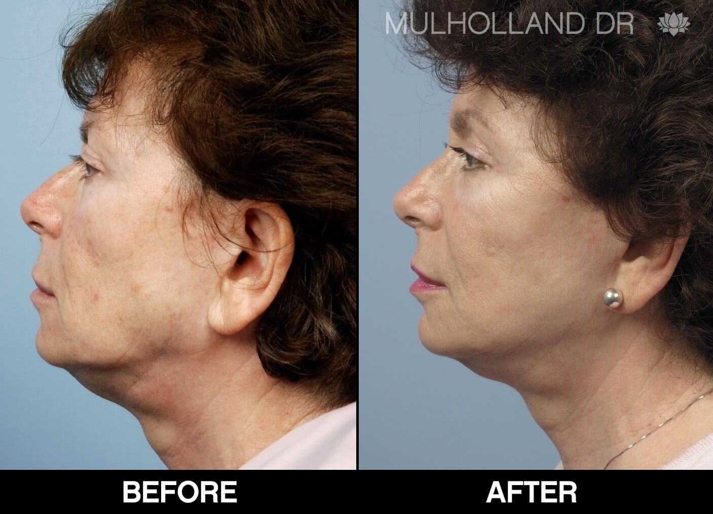 Fractora - Before and After Gallery – Photo 57