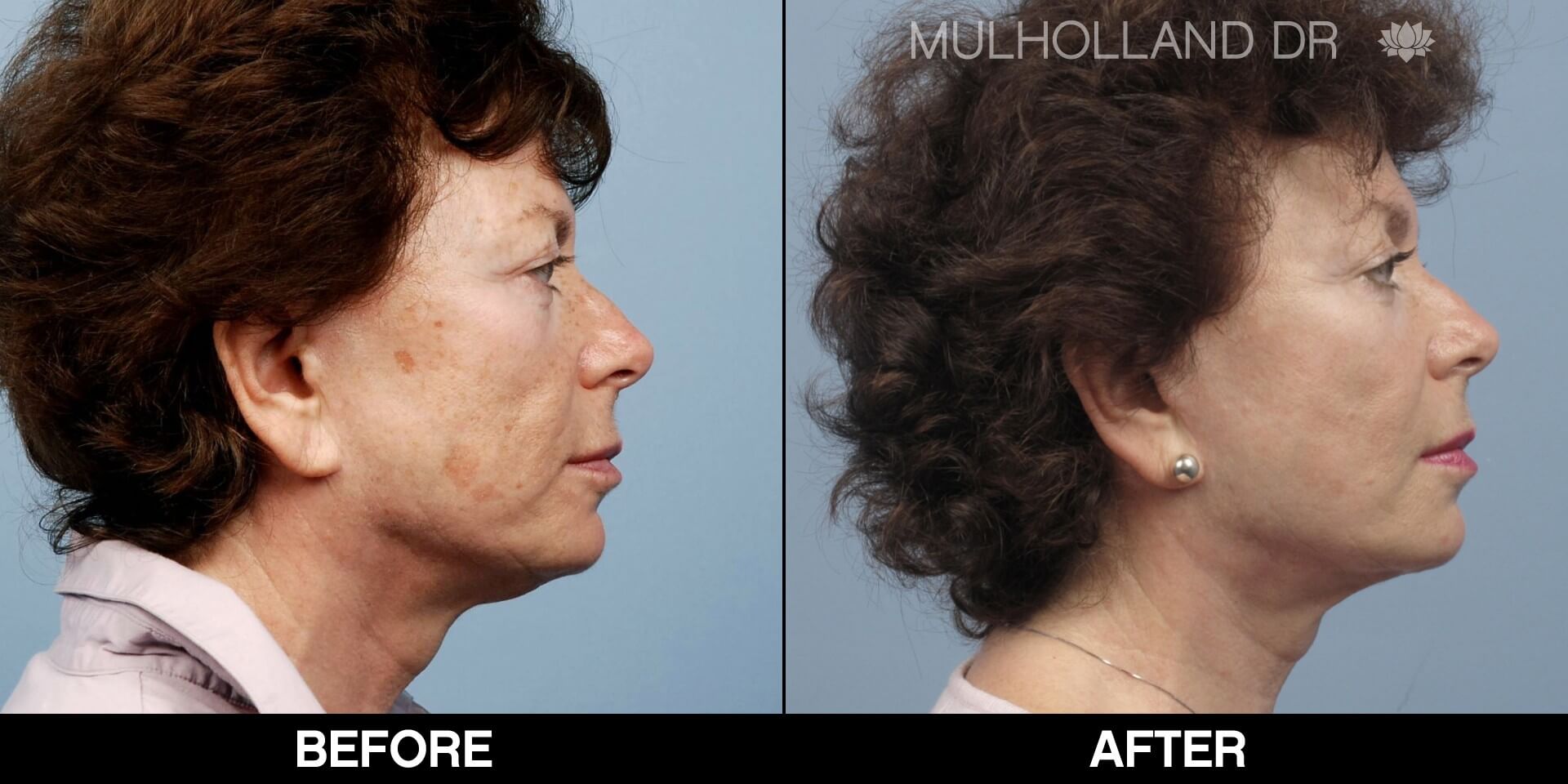 Fractora - Before and After Gallery – Photo 58