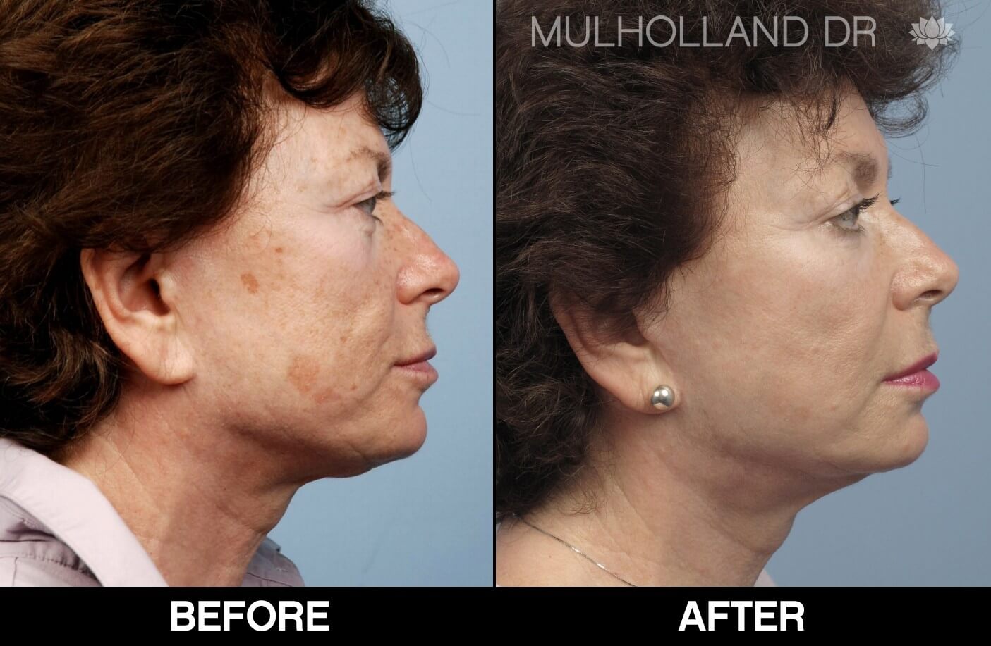 Fractora - Before and After Gallery – Photo 59