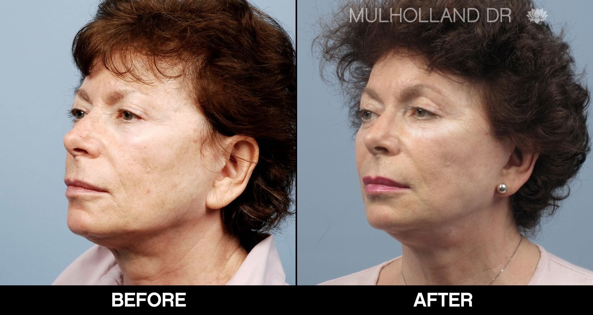 Fractora - Before and After Gallery – Photo 60