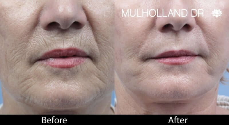 Fractora - Before and After Gallery – Photo 29