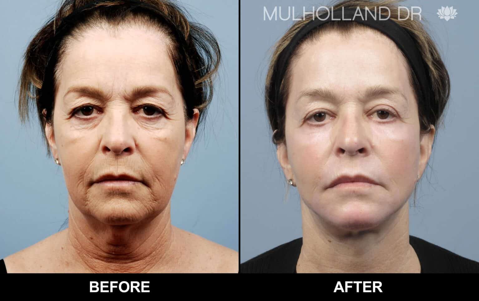 Microdermabrasion - Before and After Gallery – Photo 37