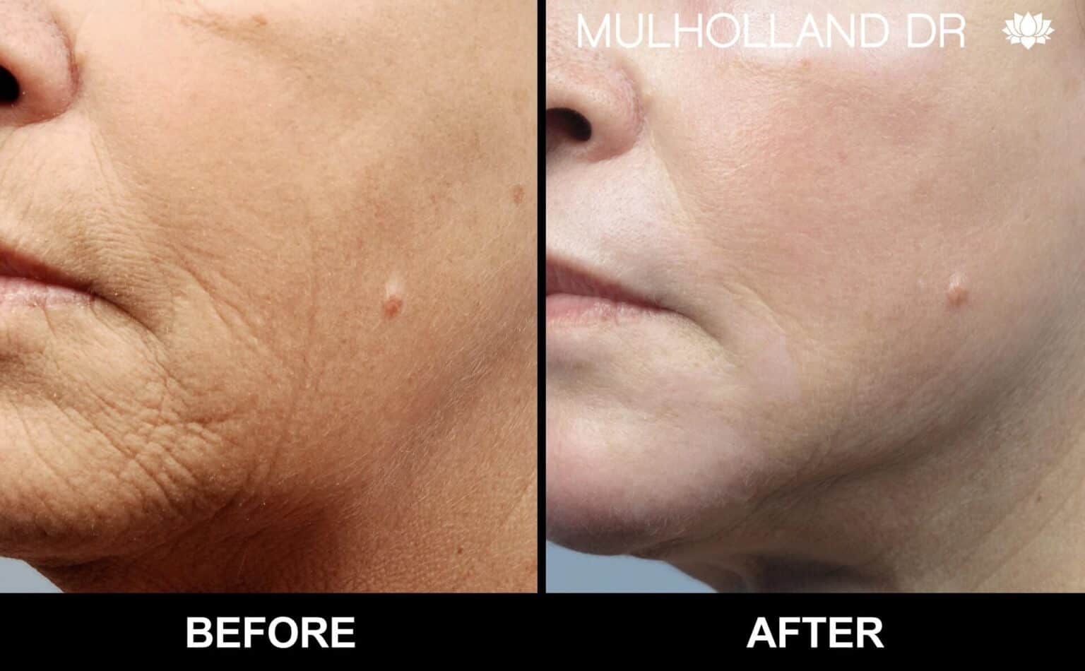 Microdermabrasion - Before and After Gallery – Photo 40