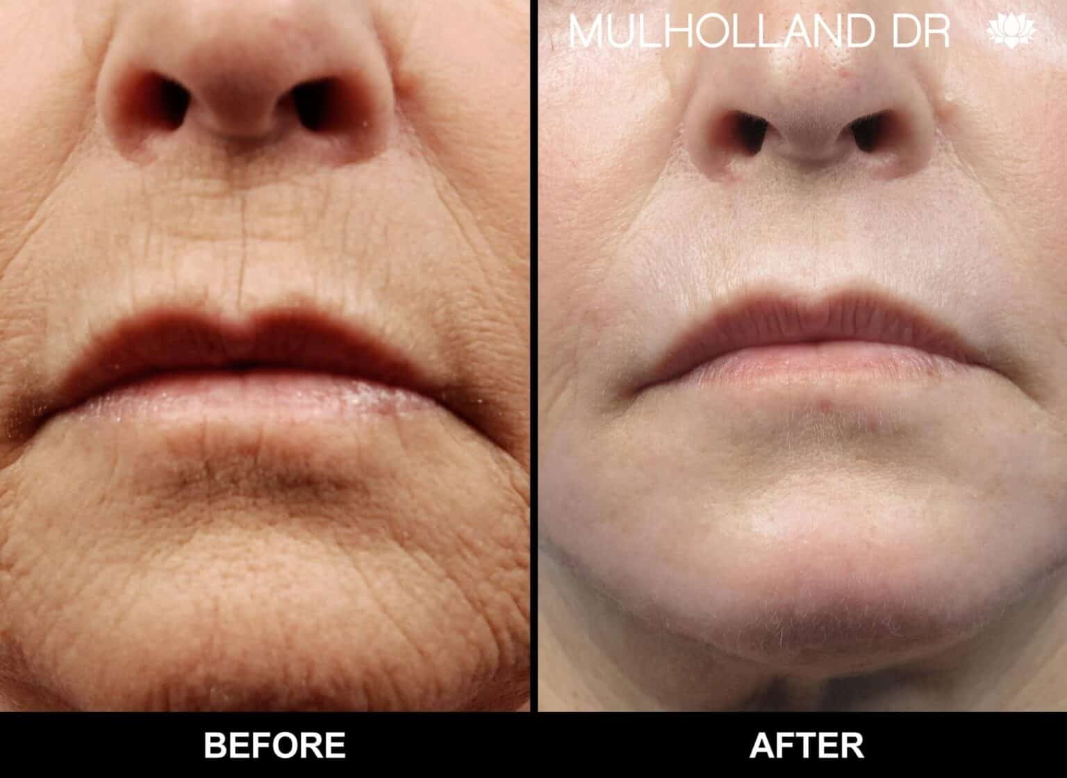 Microdermabrasion - Before and After Gallery – Photo 42