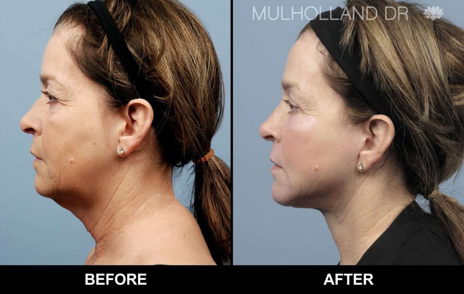 Microdermabrasion - Before and After Gallery – Photo 43