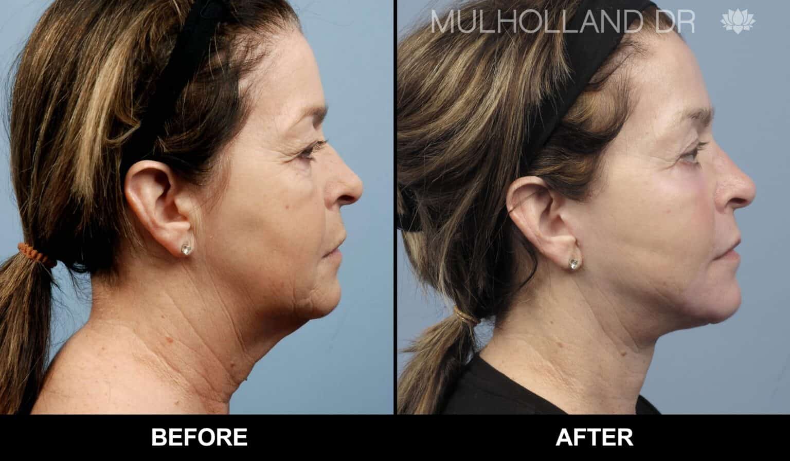 Microdermabrasion - Before and After Gallery – Photo 44