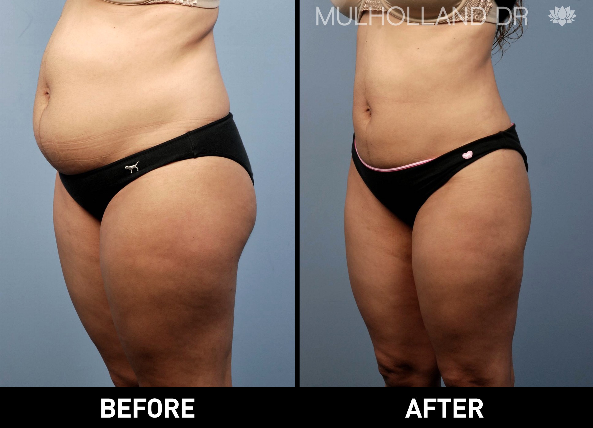 Liposuction - Before and After Gallery – Photo 14