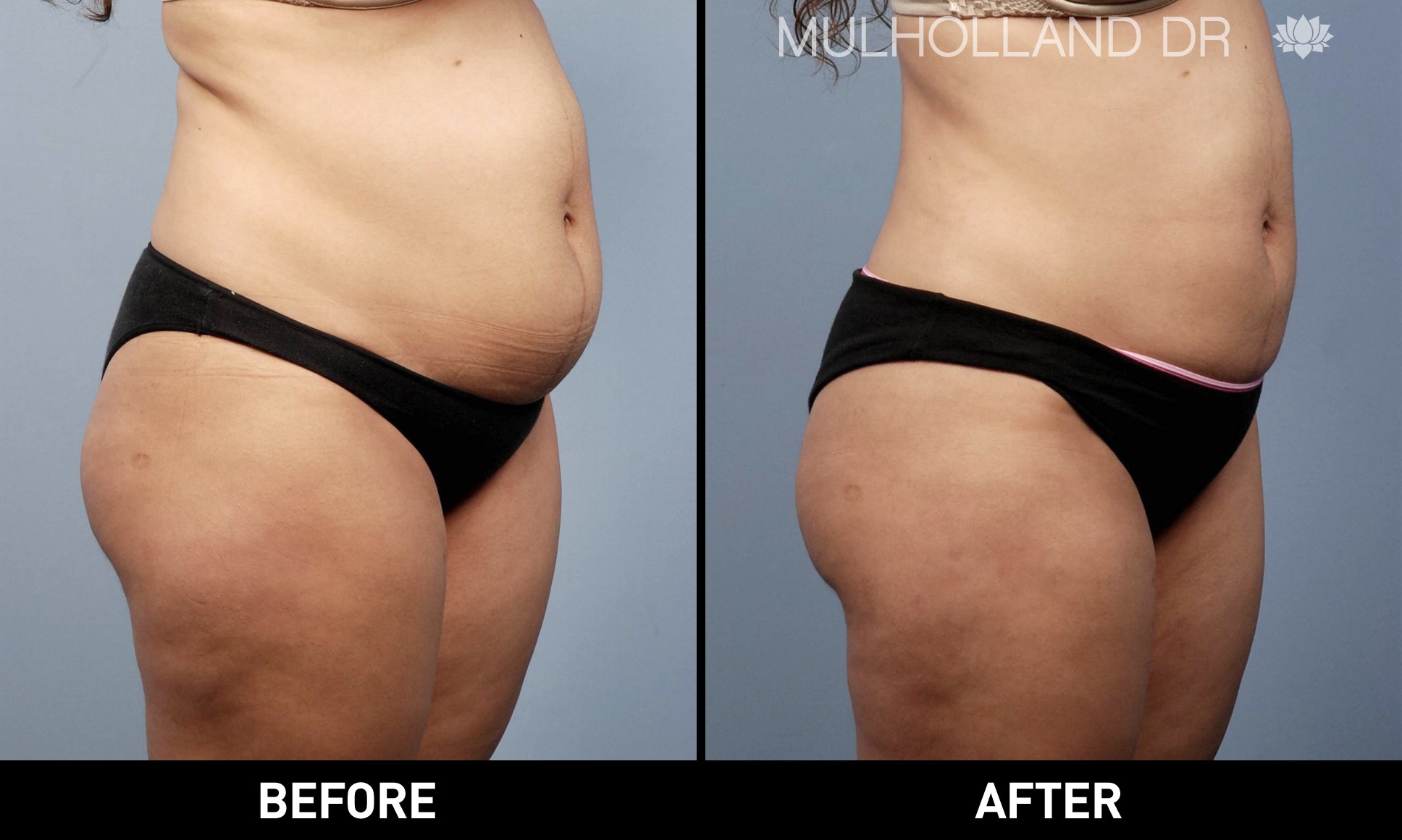 Liposuction - Before and After Gallery – Photo 15