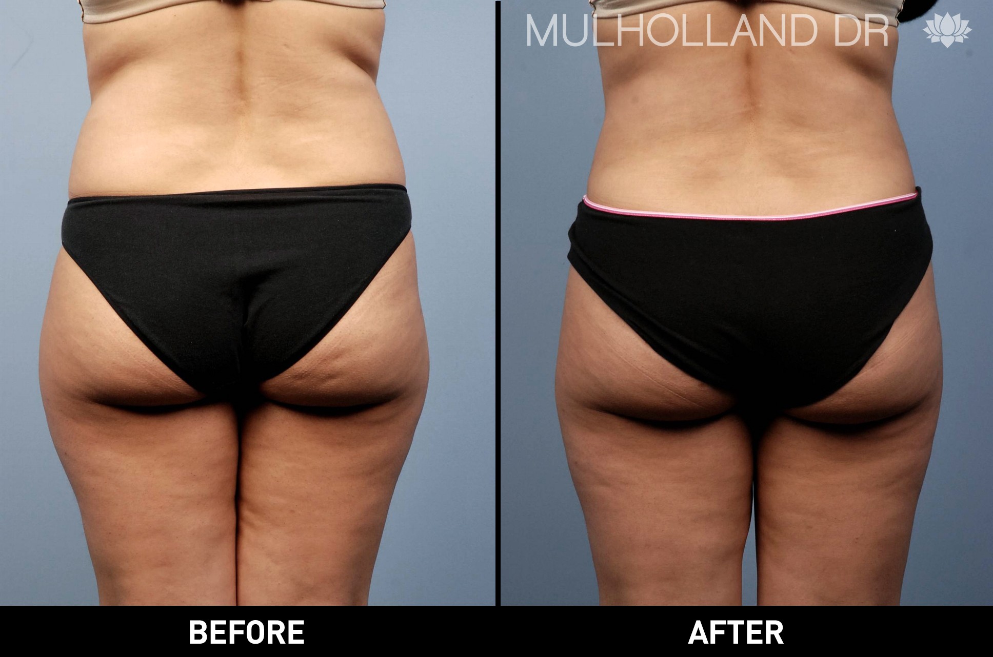 Liposuction - Before and After Gallery – Photo 16