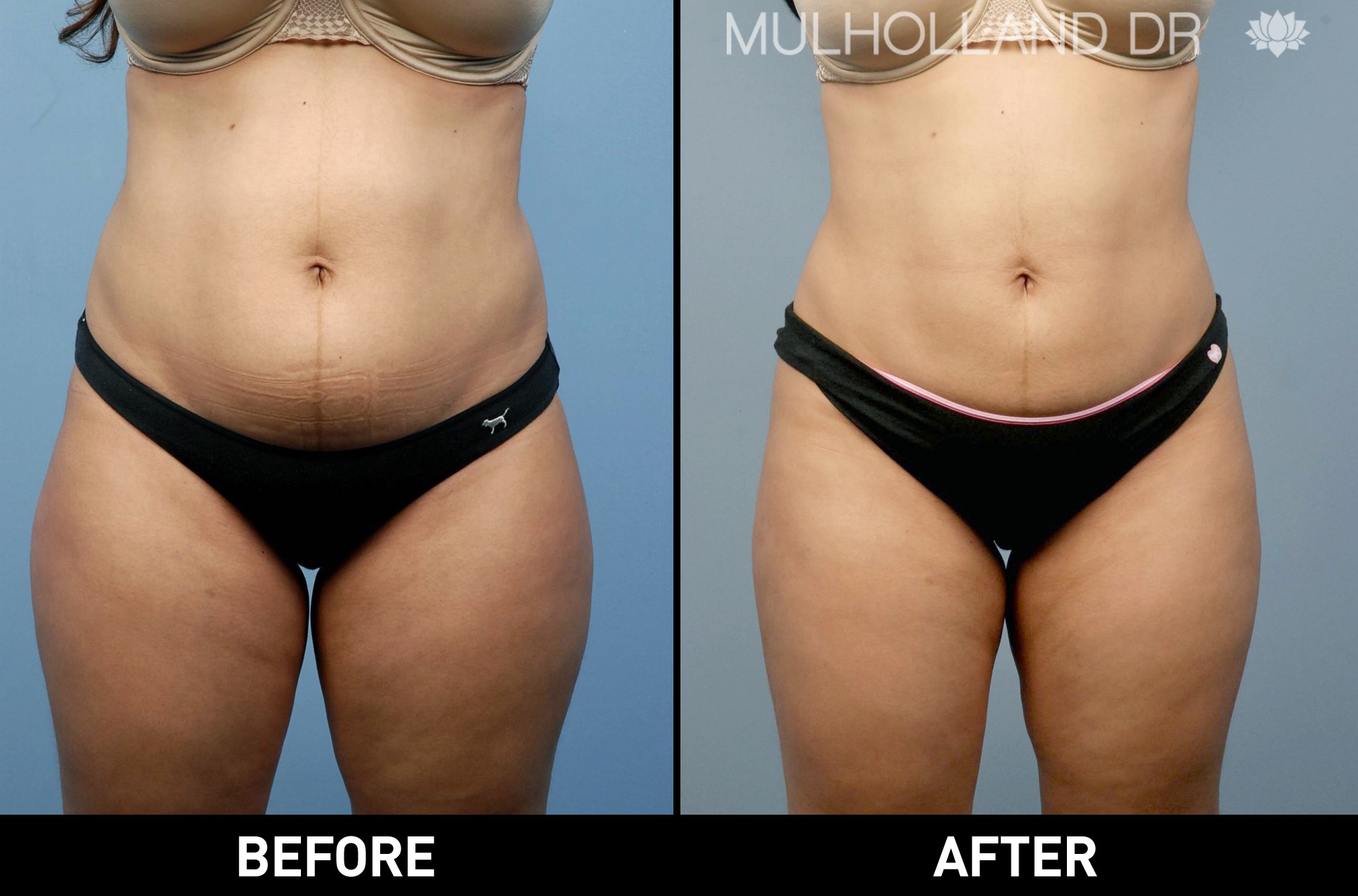 Liposuction - Before and After Gallery – Photo 17