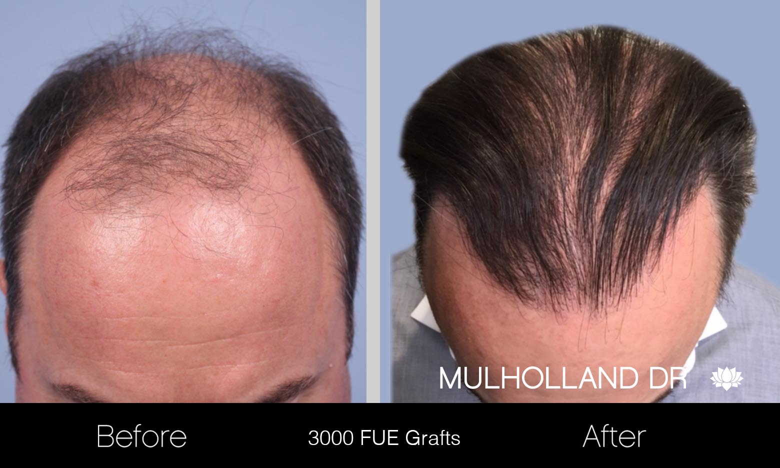 FUE Hair Male - Before and After Gallery – Photo 16