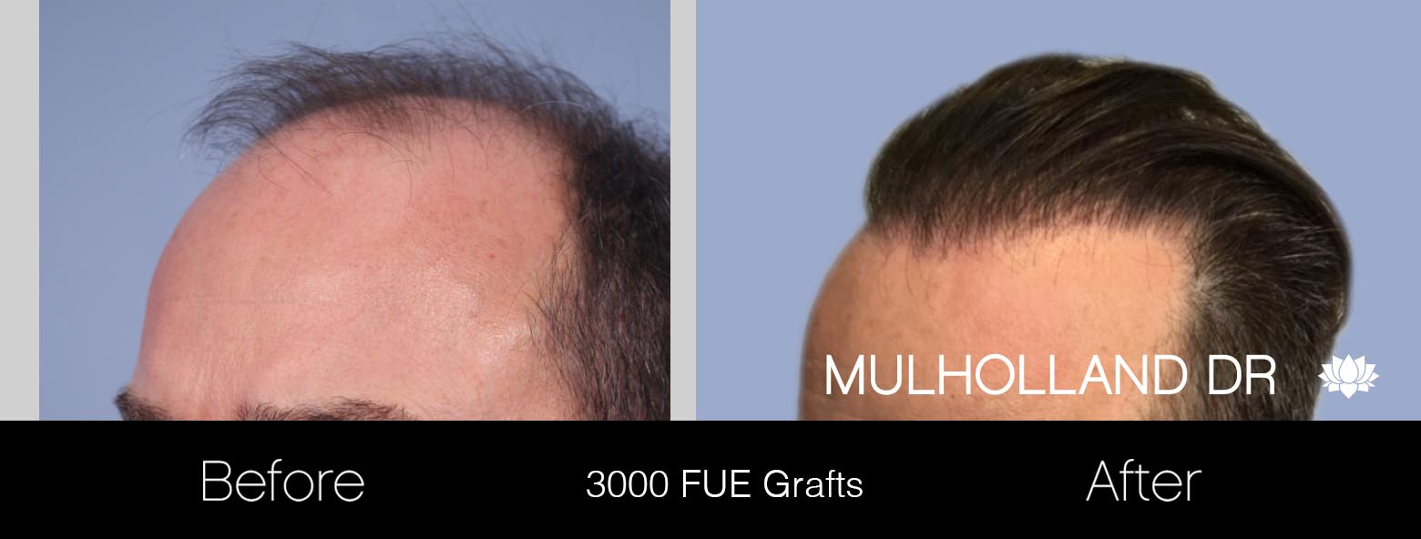 FUE Hair Male - Before and After Gallery – Photo 17