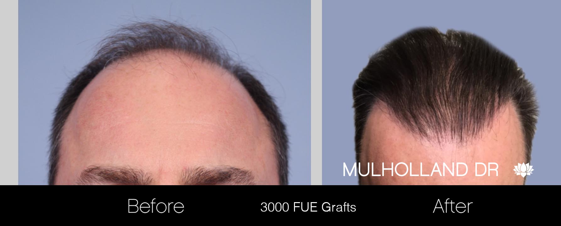 FUE Hair Male - Before and After Gallery – Photo 18