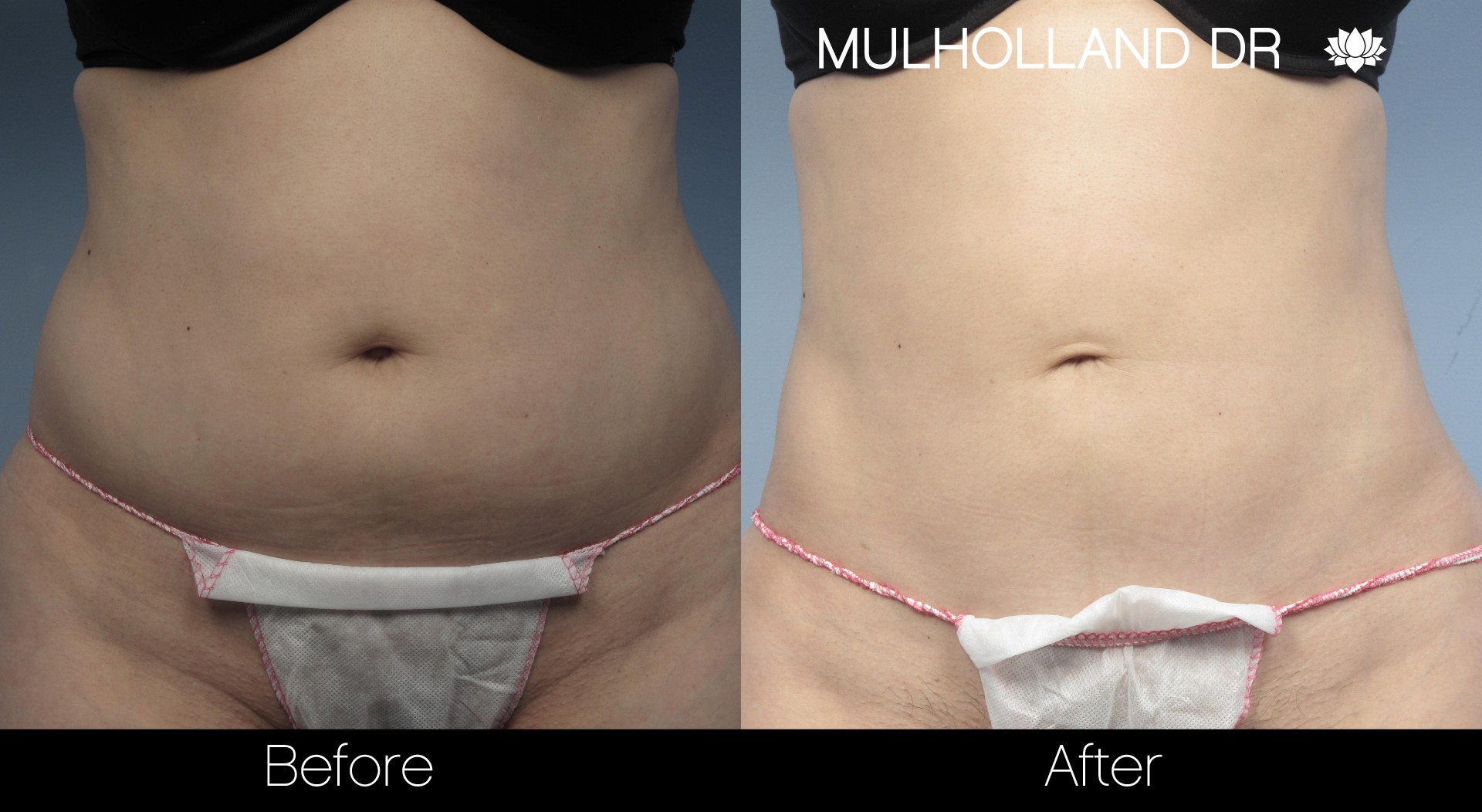 Liposuction - Before and After Gallery – Photo 20