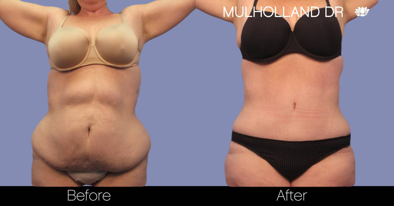 Liposuction - Before and After Gallery – Photo 1