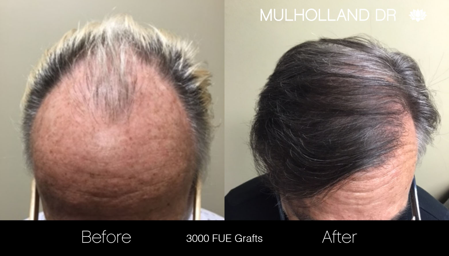 FUE Hair Male - Before and After Gallery – Photo 27