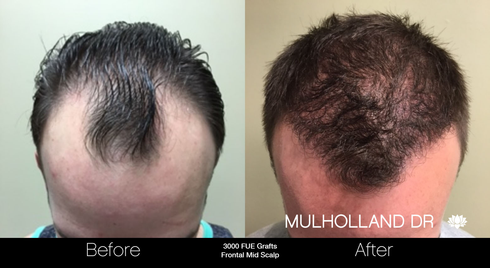 FUE Hair Male - Before and After Gallery – Photo 19