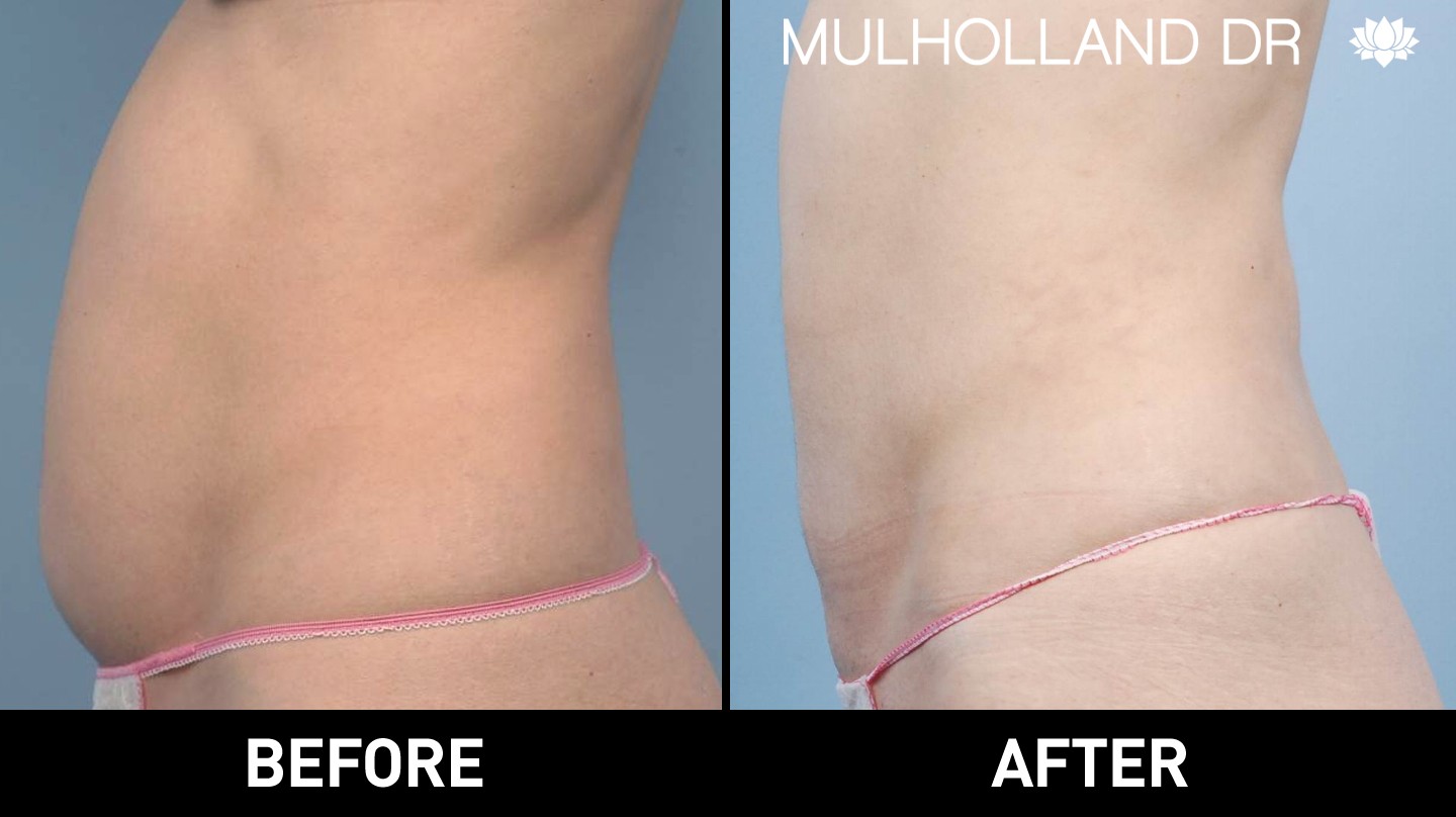 Liposuction - Before and After Gallery – Photo 24