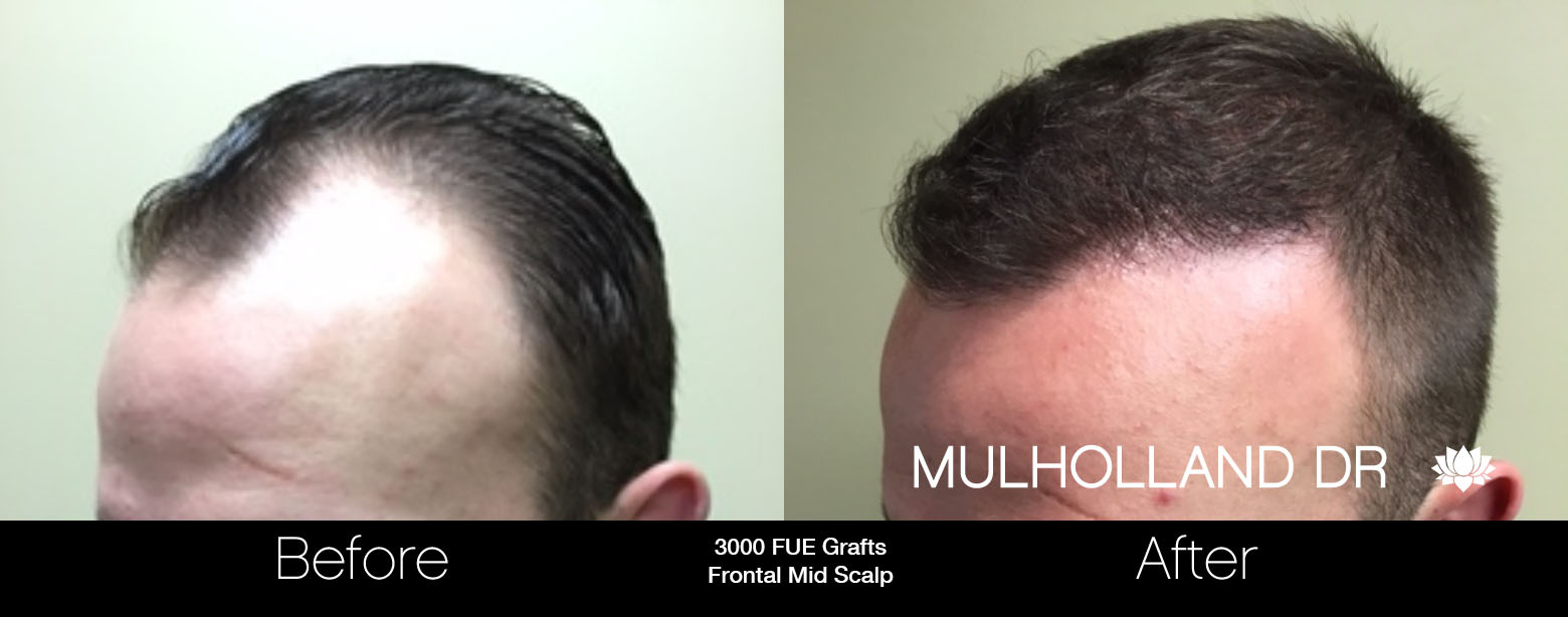 FUE Hair Male - Before and After Gallery – Photo 20