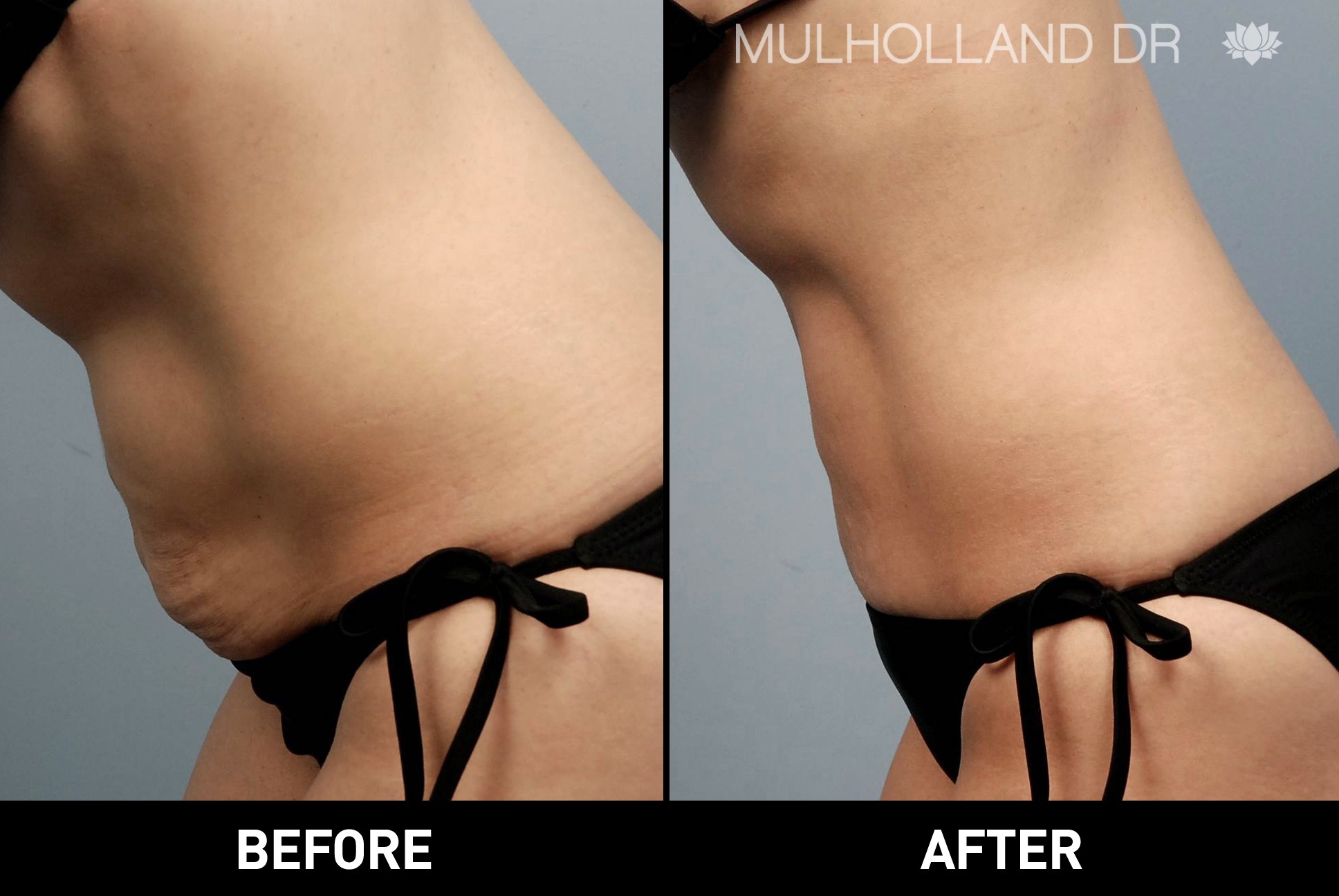 Liposuction - Before and After Gallery – Photo 25