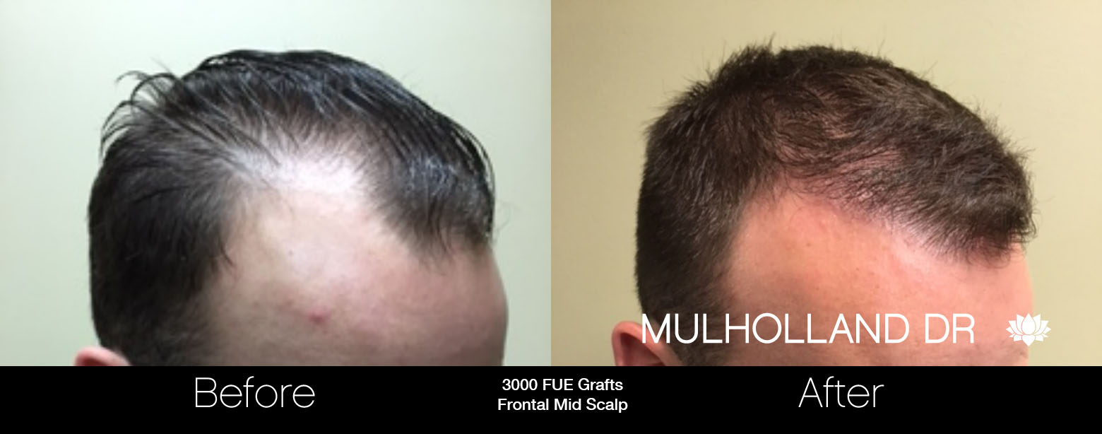 FUE Hair Male - Before and After Gallery – Photo 21