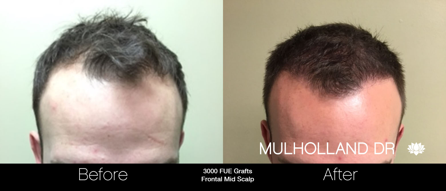 FUE Hair Male - Before and After Gallery – Photo 22