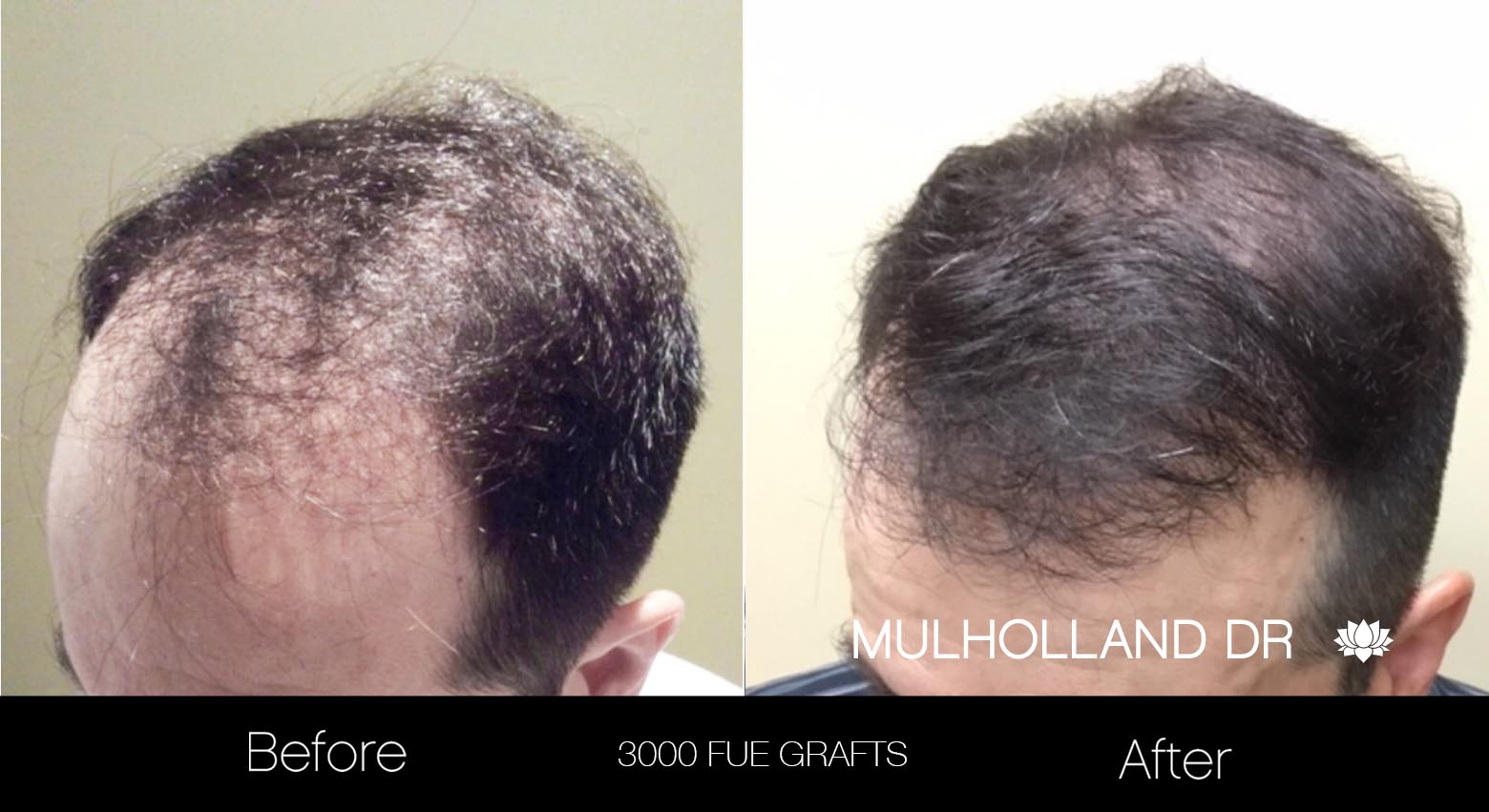 FUE Hair Male - Before and After Gallery – Photo 23