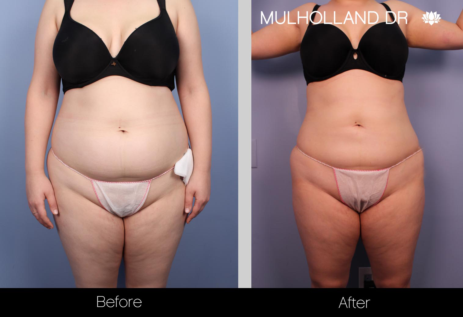 Liposuction - Before and After Gallery – Photo 28