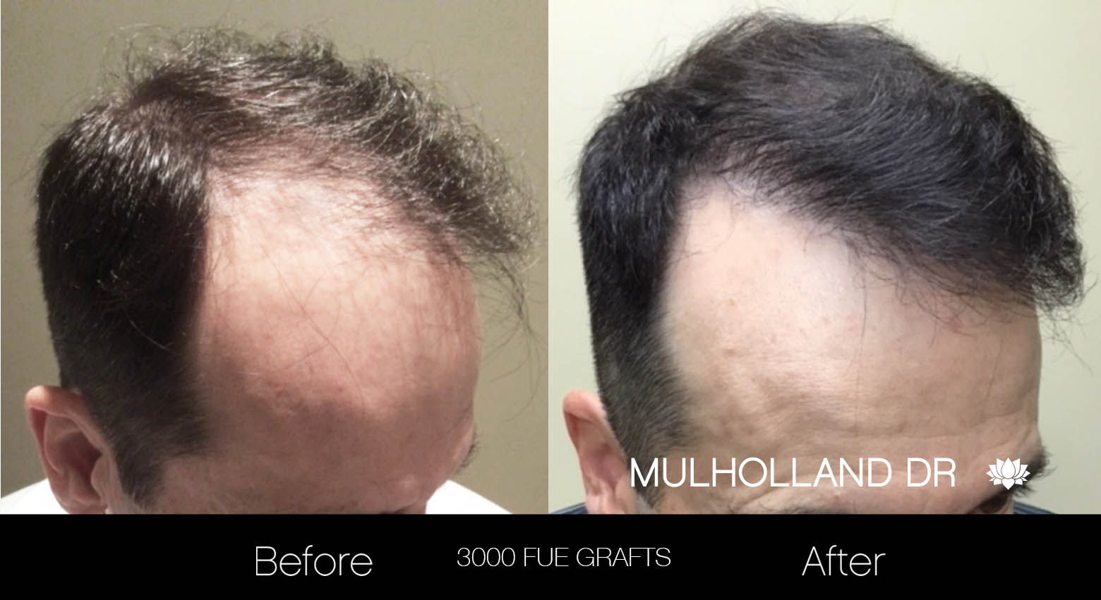 FUE Hair Male - Before and After Gallery – Photo 24