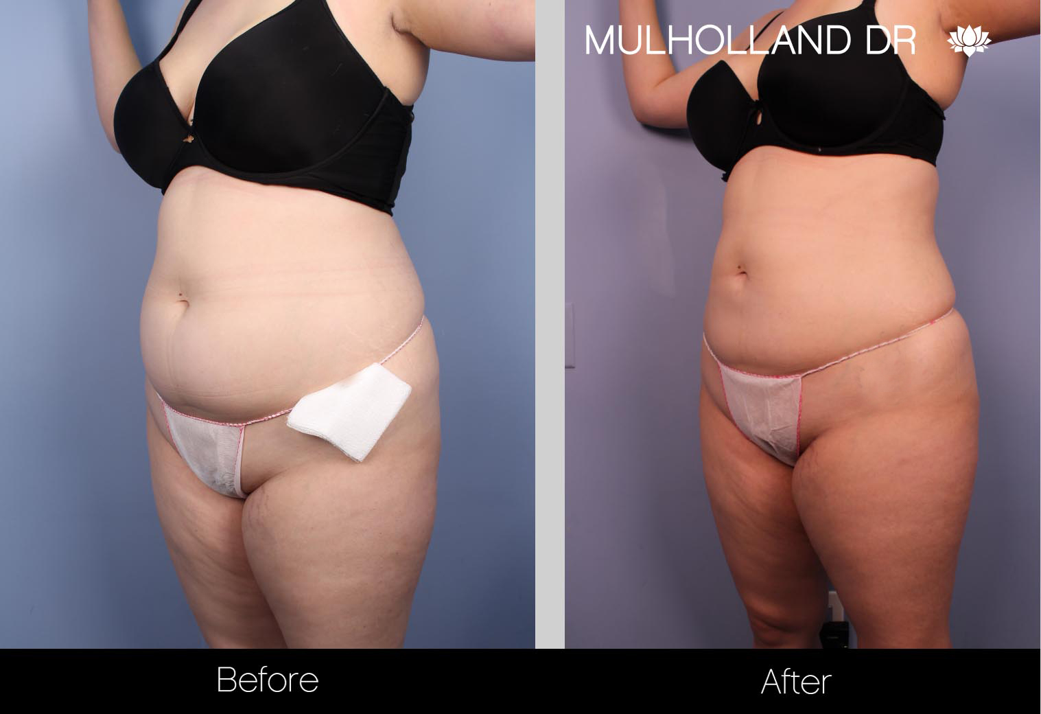 Liposuction - Before and After Gallery – Photo 29