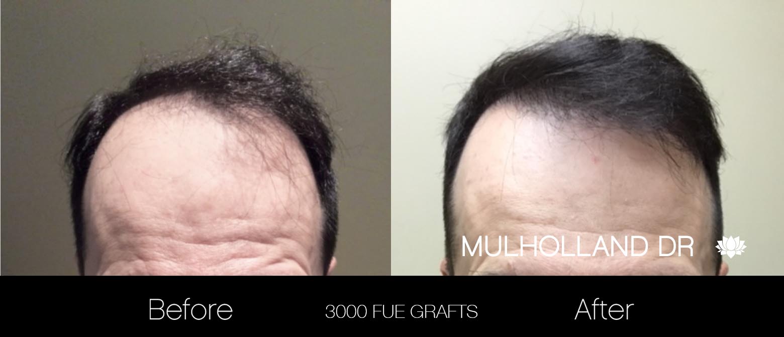 FUE Hair Male - Before and After Gallery – Photo 25