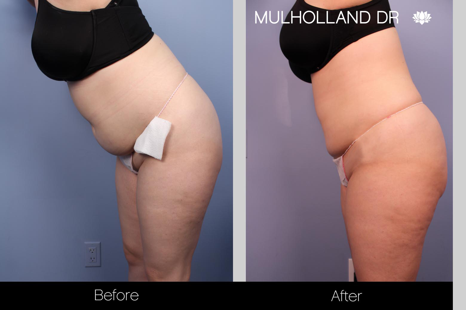 Liposuction - Before and After Gallery – Photo 30