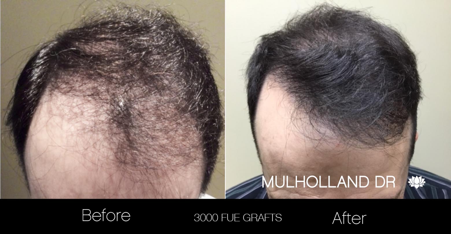 FUE Hair Male - Before and After Gallery – Photo 26