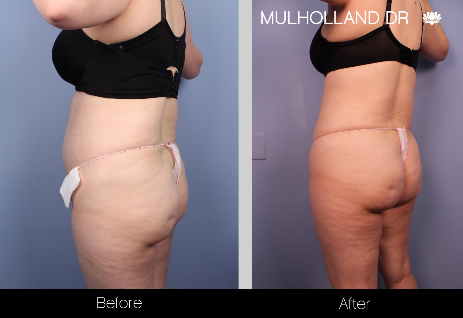 Liposuction - Before and After Gallery – Photo 31