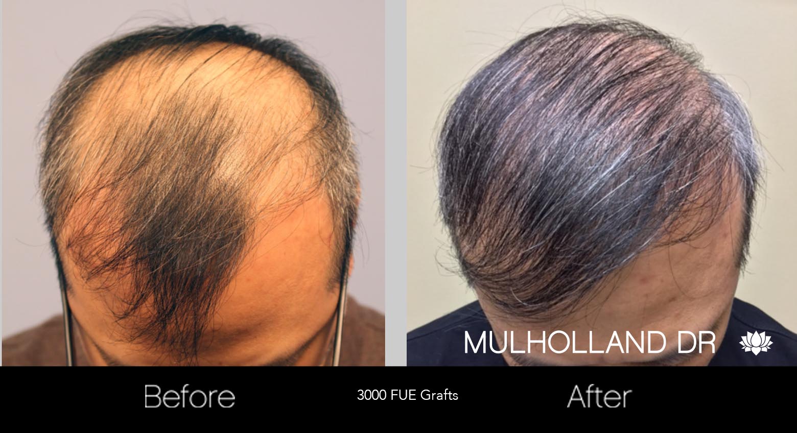 FUE Hair Male - Before and After Gallery – Photo 29