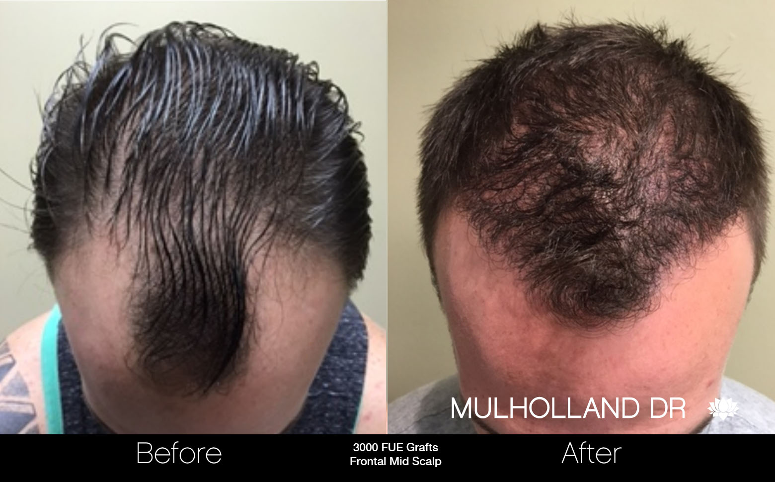FUE Hair Male - Before and After Gallery – Photo 28