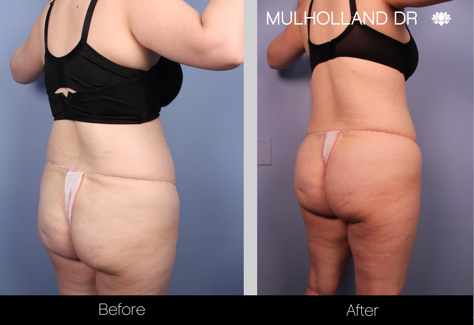Liposuction - Before and After Gallery – Photo 33
