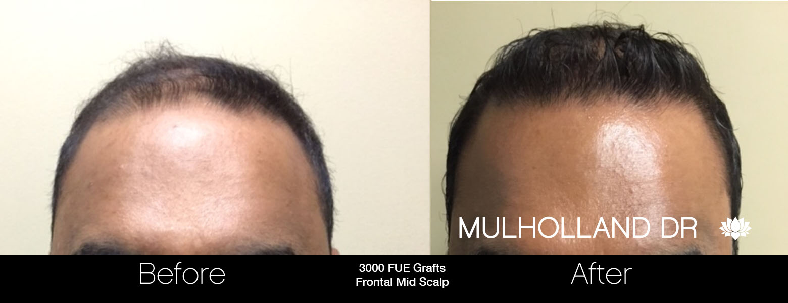 FUE Hair Male - Before and After Gallery – Photo 30